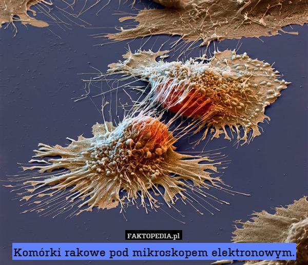 Komórki rakowe pod mikroskopem elektronowym.