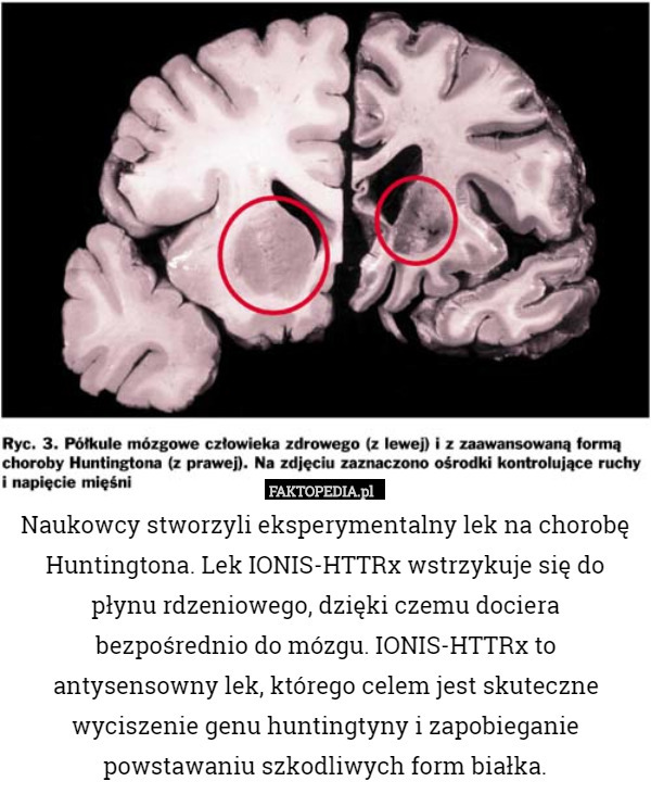 Naukowcy stworzyli eksperymentalny lek na chorobę Huntingtona. Lek IONIS-HTTRx
