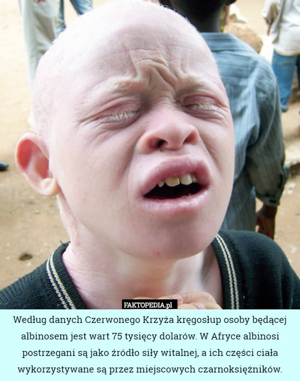 Według danych Czerwonego Krzyża kręgosłup osoby będącej albinosem jest wart