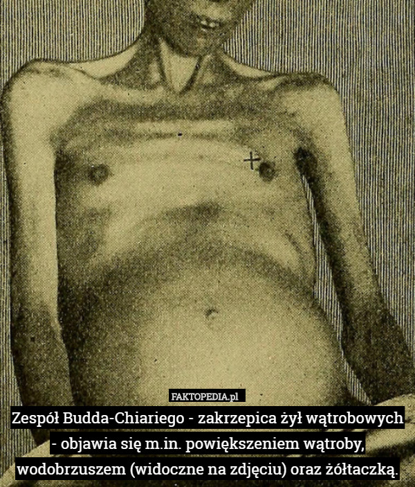 Zespół Budda-Chiariego - zakrzepica żył wątrobowych - objawia się...