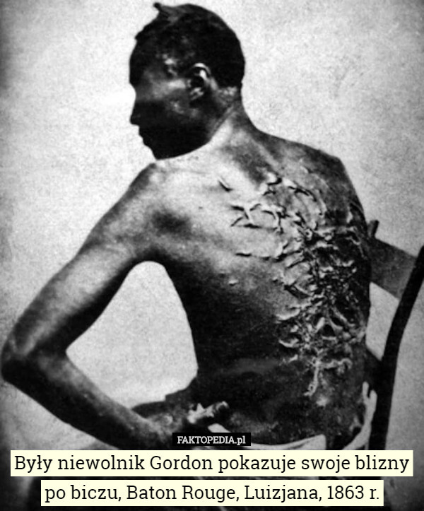 Były niewolnik Gordon pokazuje swoje blizny po biczu, Baton Rouge, Luizjana...
