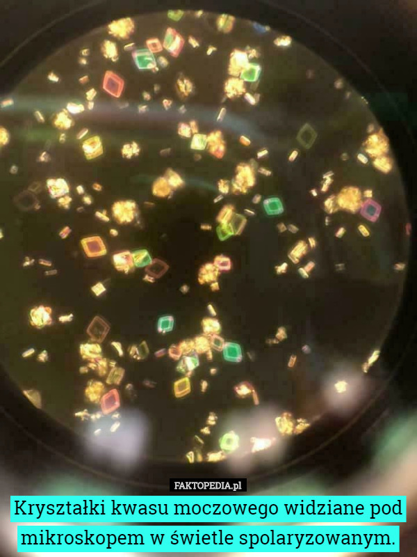 Kryształki kwasu moczowego widziane pod mikroskopem w świetle...