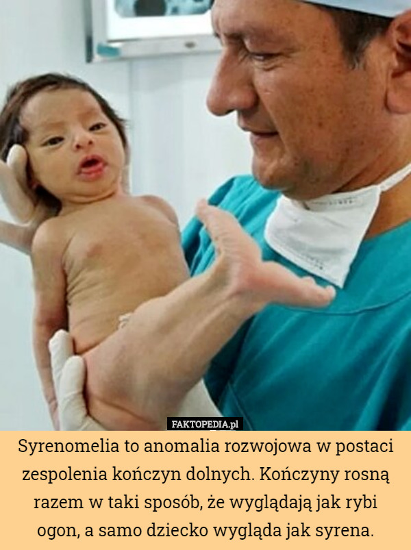 Syrenomelia to anomalia rozwojowa w postaci zespolenia kończyn...