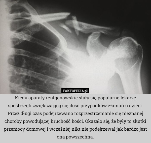 Kiedy aparaty rentgenowskie stały się popularne lekarze spostrzegli zwiększającą